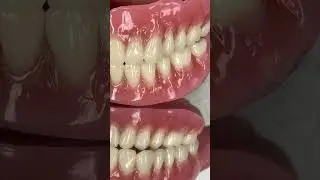 The inexpensive implant denture options!