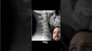 Why I Hate the Chin Tuck Exercise: Insights from My Neck X-rays #ChinTuckExercise #NeckPainRelief