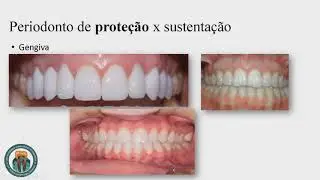 LAUP - Introdução a Periodontia