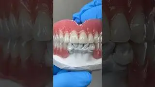 Immediate #Denture and Duracetal Partial #teeth #smile #lsk121shorts #dentures #shorts #shortvideo