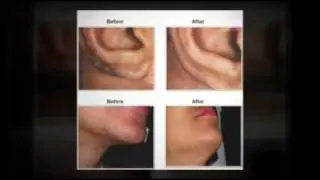 Lasoderm Advanced Laser Hair Removal - Facials in Austin, TX