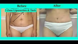 Liposuction-Jplasma Special