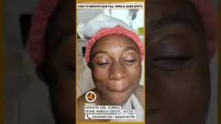 HOW TO REMOVE SKIN TAGS, DPNs & DARK SPOTS &mdash; REAL RESULTS! 😱✨