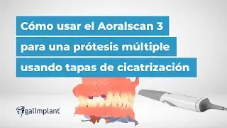 💻 C&oacute;mo utilizar el esc&aacute;ner intraoral Aoralscan 3 en una pr&oacute;tesis m&uacute;ltiple con tapas de cicatrizaci&oacute;n
