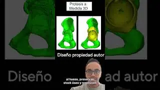Como diseñar implantes acetabulares en 3D, QUE DICE LA EVIDENCIA CIENTICA?