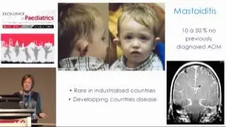 Acute Otitis Media, Antibiotics now, later, never?