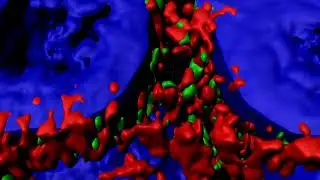 3D surface rendering of high resolution confocal imaging of SFTPB and ABCA3 in ABCA3 Mutation.