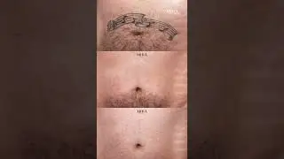 Does Laser Tattoo Removal cause scars?