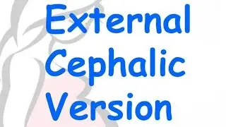 External Cephalic Version ECV ;medical procedure to turn baby from a breech position feet or buttock