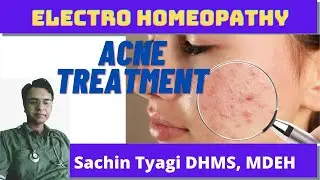Electro Homeopathic medicine for acne | Pimples | Blackheads | Whiteheads