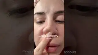 Sebaceous filaments 🤮