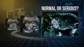 Echogenic Bowel Ultrasound: Soft Marker or Something More Serious?