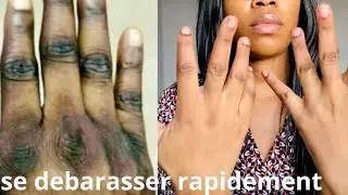 COMMENT SE DÉBARRASSER DES QUINTOS RAPIDEMENT 💯naturel,très efficace 🔥