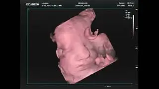 32 Weken Echo, 3D Live Filmpje