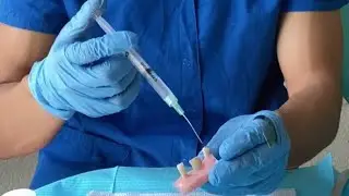 T&eacute;cnica de fuerzas balanceadas/ instrumentaci&oacute;n Crown-Down endodoncia