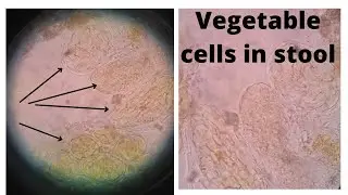 Vegetable cell in Stool | Stool examination microscopic @medicallabtechnologysajal6903