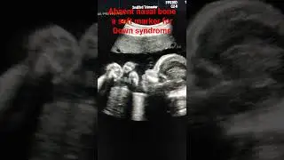 Absent Nasal bone a soft marker for fetal aneuploidy