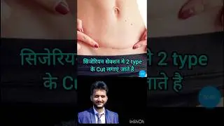 cesarean section c-section #pregnancy #delivery  operation delivery #shorts