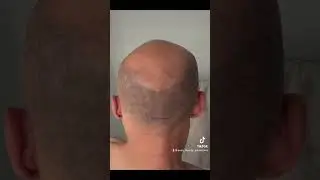 #beforeandafter #laserhairremoval #scalp #bald #manscaping #grooming #checkitout
