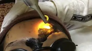 Carbon Gel for Nd yag laser cabron peeling treatment