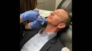 Male Chin Enhancement Using Restylane Defyne
