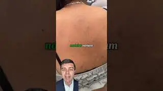 Prurigo nodular #dermatologista