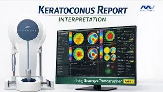 How to Interpret Keratoconus Using SCANSYS Tomographer: A Map-by-Map, Case-Based Approach