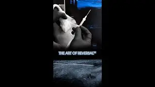 Dissolving Filler with Ultrasound Technology - The Art of Reversal