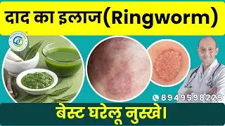 Ringworm treatment के लिए बेस्ट घरेलू नुस्खे | Home Remedies | Daad khaj khujli ka ilaj