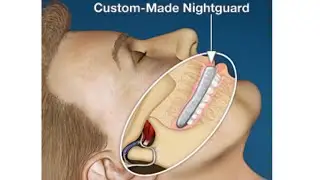 Dental Night Guard vs Boil and Bite Guard Which to Choose???