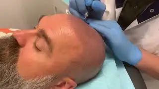 De specialist van Nederland op het gebied van Micro haar pigmentatie/ stoppeltattoo kaalheid
