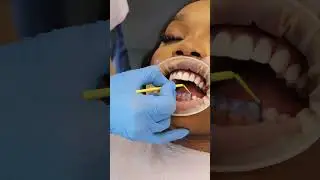 Enhance Your Smile with Dentatur Dental Clinic's Veneers!