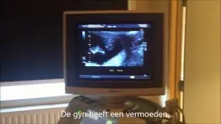 Tweeling geslacht : 13 weken 5 dagen ' vermoeden, 2 meisjes '