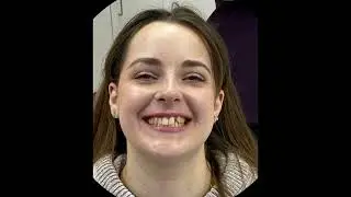 Congenitally missing front tooth