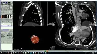 TOF POST PROCESSING UPON  VITREA 6