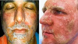 5 Great Sins Mistakes Of Exfoliation That Will Permanently Destroy Your Skin.