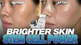 Real Skin Brightening with Microneedling? | Dull to Radiant in 7 Days!