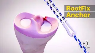 RootFix Anchor | 3D Medical Animation