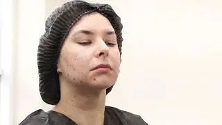 SuneKOS Performa Обличчя - протокол інєкцій Fullface