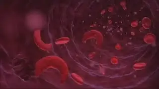 The True Cause of Sickle Cell Anemia