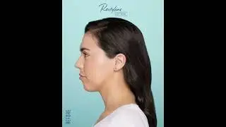 Chin Retrusion - How Restylane Injectables can help correct Chin Intrusion.