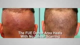 Advantages of FUE Hair Transplant Surgery  by Dr. Michael Vories | Charlotte, NC