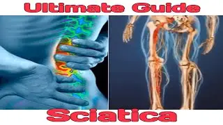 SCIATICA Ultimate Chiropractic Guide & Exercise! Dublin City Chiropractic