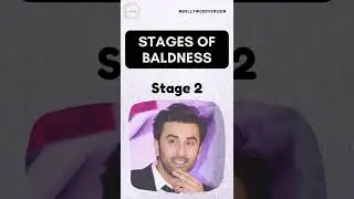 Etapy łysienia z udziałem gwiazd Bollywood | Klinika przeszczepu włos&oacute;w | Centrum Medyczne Dadu Trychologia