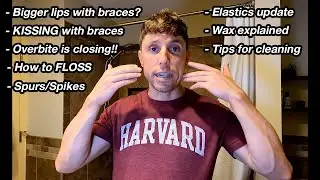 Adult Braces Journey | 9 Month Update