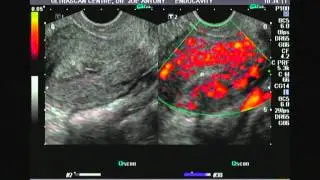 Hyperemia of uterus- Power Doppler video