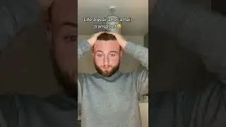 Hair Transplant Recovery After 1 Year