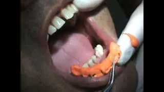 Impresi&oacute;n de Implantes