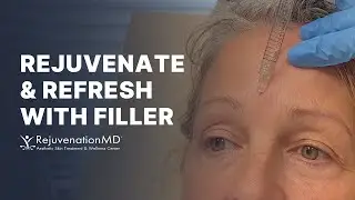 Beautiful Filler for Frown Lines and Lips