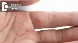 Possible causes of 'White hard bumps' on hands & fingers with its management - Dr. Rasya Dixit